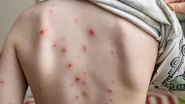 Okullarda suçiçeği alarmı: Vakalar yeniden artışta